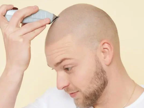 The Benefits of Scalp Micropigmentation for Thinning Hair