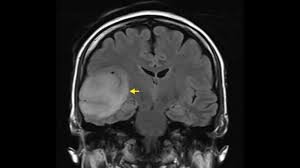 Neuroradiology's Role in Understanding Brain Connectivity
