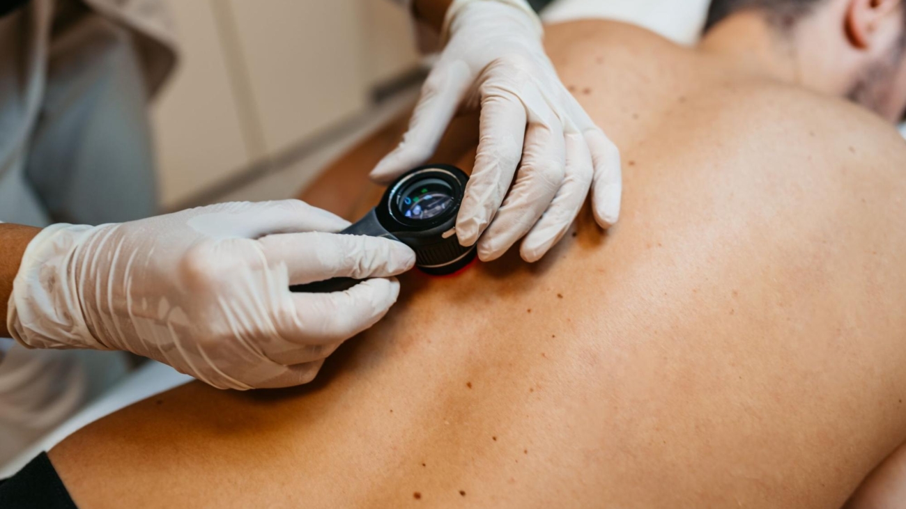 How Dermatologists Identify Early Symptoms of Skin Cancer